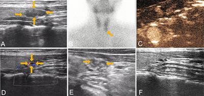 Bone Turnover Markers in Response to Ultrasound-Guided Microwave Ablation for Primary Hyperparathyroidism